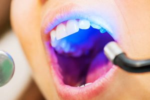 closed up teeth receiving dental treatment